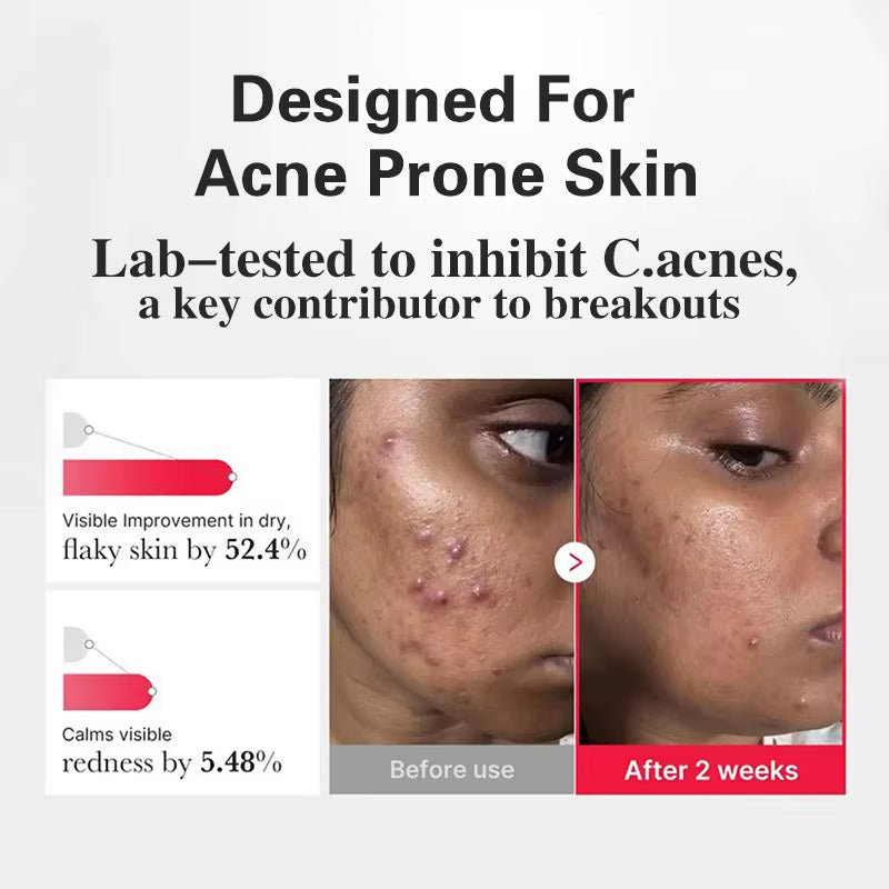 Custom Logo Sensitive Skin Redness Facial Serum Hypochlorous Face Body Soothing Hypochlorous Acid Exfoliating Peeling Acne Serum